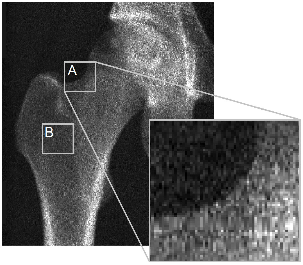 Example DXA hip scan of a young adult acquired using the GE iDXA scanner.